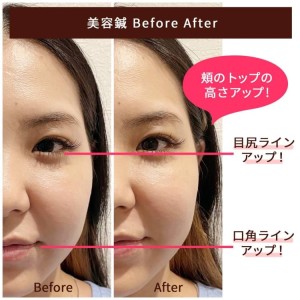 美容鍼ビフォアアフター